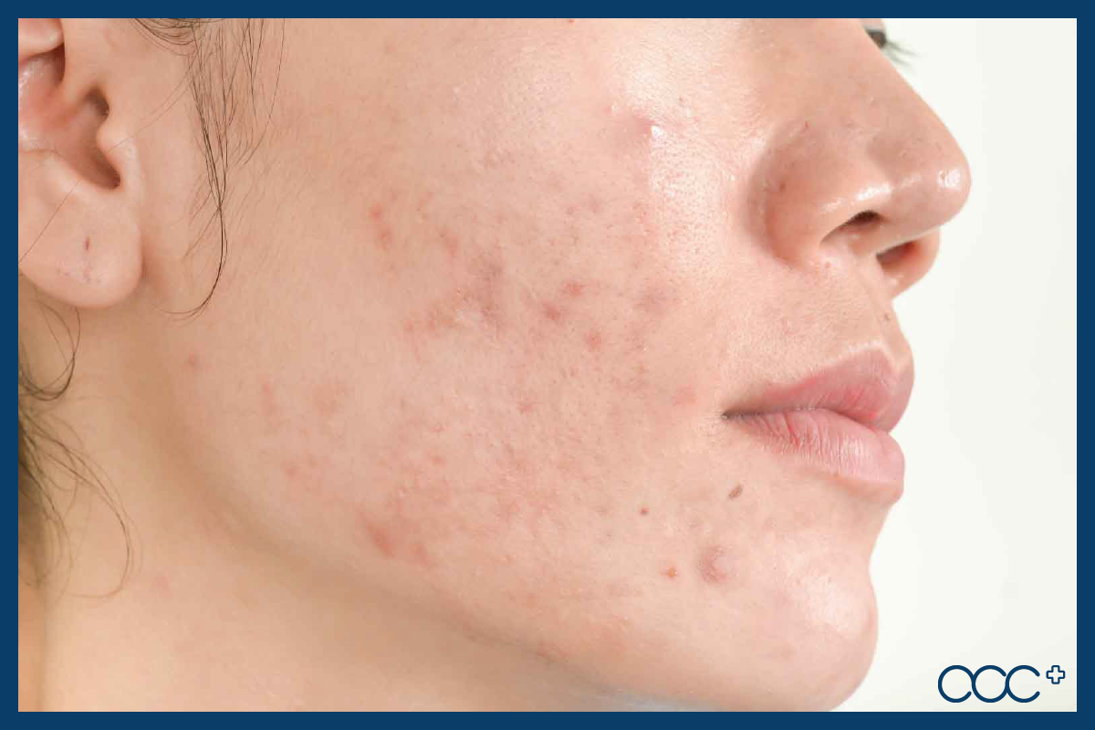 【accmask】擊退口罩肌👩👩👧台灣口罩的最強秘密💕