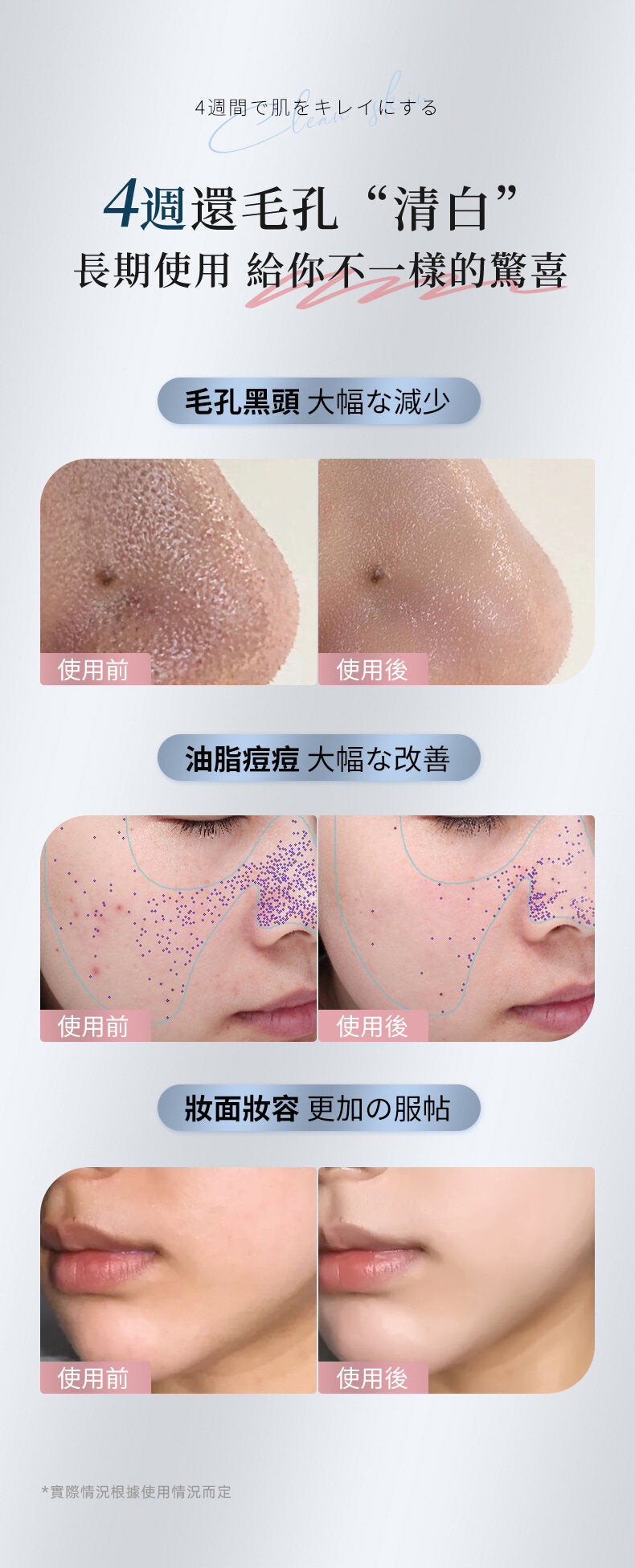 Jujy - 超音波極致淨顏彩光鏟皮機|去黑頭|收毛孔|去角質|補水保濕|提拉緊致|導出導入