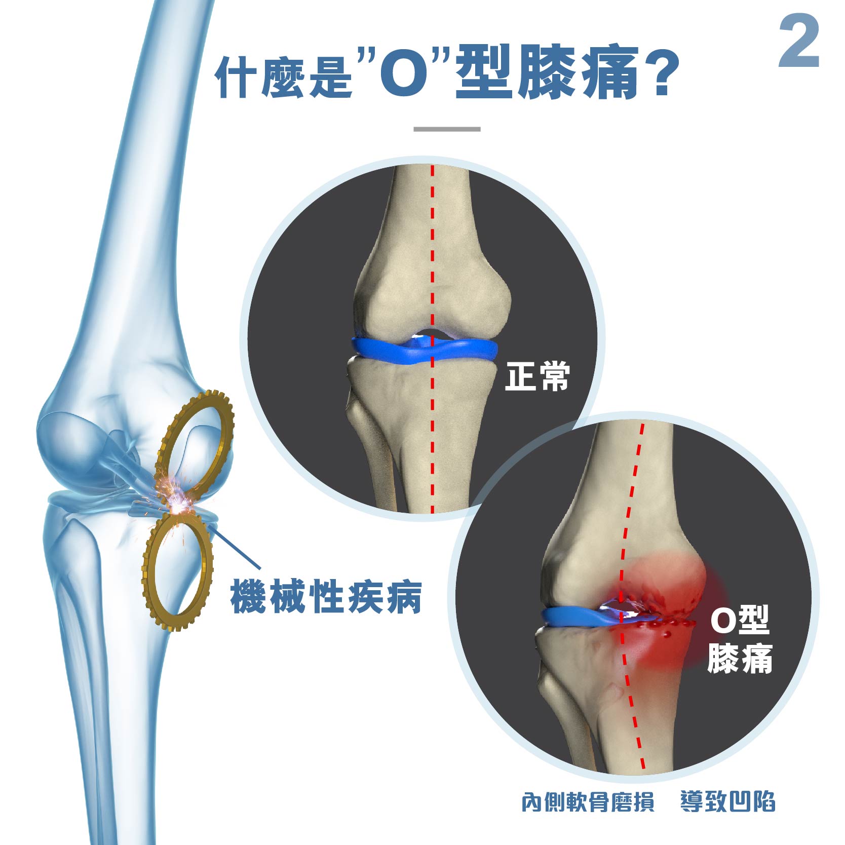 Medex 隱形拐杖（O形膝頭矯形器）（K39d）