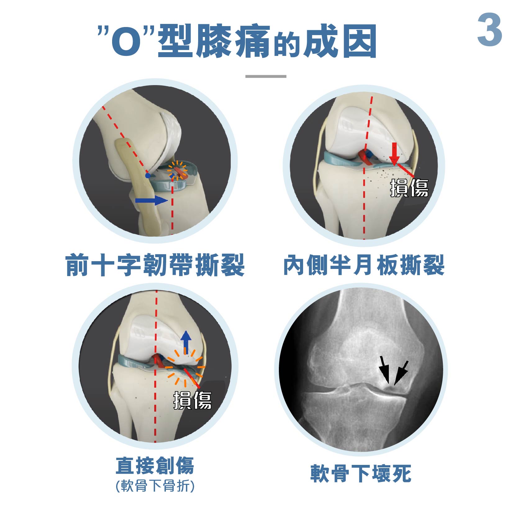 Medex 隱形拐杖（O形膝頭矯形器）（K39d）