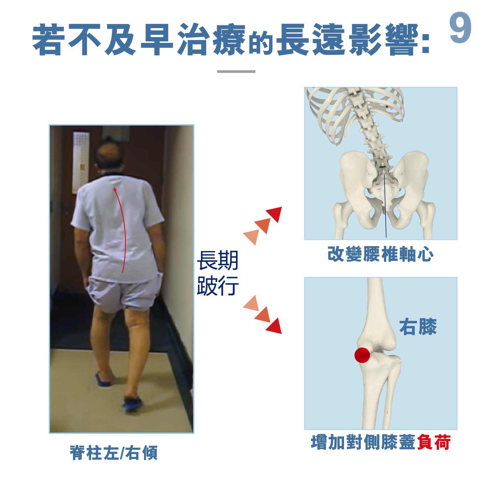 Medex 隱形拐杖（O形膝頭矯形器）（K39d）